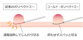 従来のポリペクトミーとコールド・ポリペクトミー