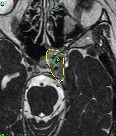 下垂体腫瘍に対するガンマナイフ治療計画（図1）（各球状照射野を腫瘍のみに配置し、脳神経への過照射を避ける）