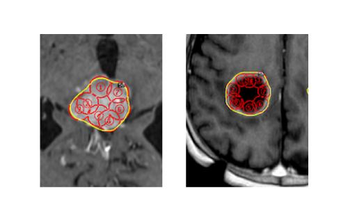 転移性脳腫瘍に対するガンマナイフ治療計画