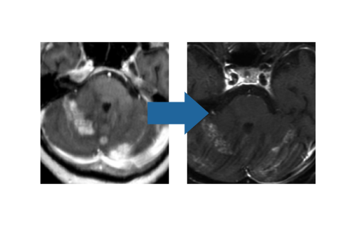ガンマナイフ著効例（図3）