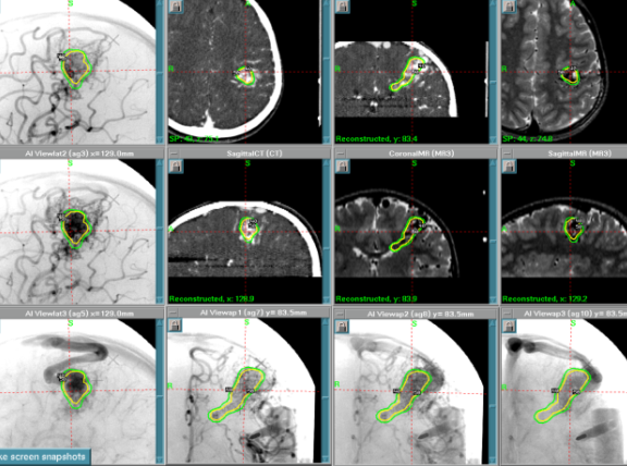 脳動静脈奇形に対するガンマナイフ治療