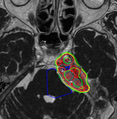 髄膜腫に対するガンマナイフ治療