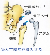 人工骨頭置換術（人工関節を挿入する）