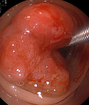 大腸CT検査（同部位の実際の大腸内視鏡像）