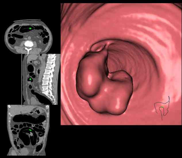 大腸CT検査（CTによる仮想内視鏡像）